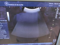 超音波診断装置（カラードプラ）｜LOGIQ P5｜GEヘルスケアの写真4枚目