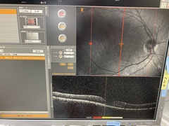Optical Coherence Tomography｜RS-3000｜'' photo4