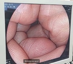 Video Colonoscope｜EC-L590ZW｜Fujifilm Medical photo5