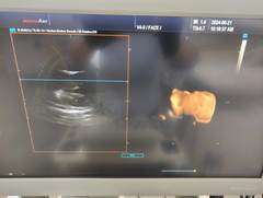 超音波画像診断装置｜ACCUVIX A30｜サムソン電子ジャパン株式会社の写真5枚目