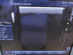 超音波診断装置（カラードプラ）｜LOGIQ P5｜GEヘルスケアの写真5枚目