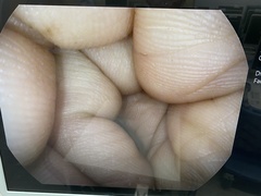 大腸ビデオスコープ｜EC38-i10M｜ペンタックスの写真5枚目