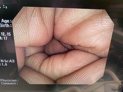 Video Colonoscope｜CF-Q240AI｜Olympus Medical Systems photo5