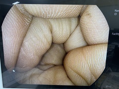 Colonoscope｜EC34-i10M｜Pentax photo5