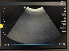 超音波診断装置｜Lumify｜フィリップスの写真5枚目