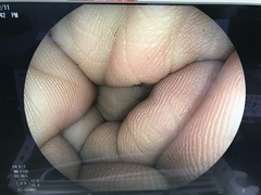 Video Colonoscope｜EC-590WM3｜Fujifilm Medical photo6