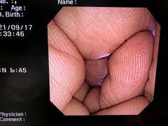 Video Transnasal Gastroscope｜GIF-XP260N｜Olympus Medical Systems photo6