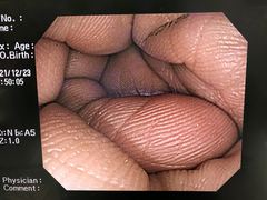 Video Colonoscope｜PCF-Q260AI｜Olympus Medical Systems photo6