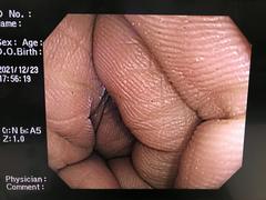 Video Colonoscope｜PCF-Q240ZI｜Olympus Medical Systems photo6