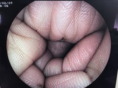 大腸ビデオスコープ｜EC-3000MP｜富士フイルムメディカルの写真6枚目