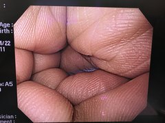 上部消化管汎用ビデオスコープ｜GIF-Q240｜オリンパスメディカルシステムズ株式会社の写真6枚目