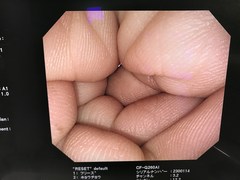 大腸ビデオスコープ｜CF-Q260AI｜オリンパスメディカルシステムズ株式会社の写真6枚目