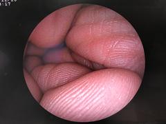 上部消化管用経鼻スコープ｜EG-3000N｜富士フイルムメディカルの写真6枚目