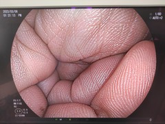 大腸ビデオスコープ｜EC-600WM｜富士フイルムメディカルの写真6枚目