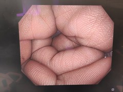 大腸ビデオスコープ｜PCF-H290I｜オリンパスメディカルシステムズ株式会社の写真6枚目