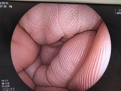 大腸ビデオスコープ｜EC-590WM3｜富士フイルムメディカルの写真6枚目