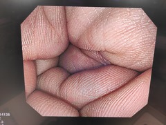 大腸ビデオスコープ｜PCF-Q260AI｜オリンパスメディカルシステムズ株式会社の写真6枚目