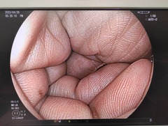 下部消化管用拡大スコープ｜EC-L600ZP｜富士フイルムメディカルの写真6枚目