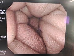 大腸ビデオスコープ｜PCF-Q240ZI｜オリンパスメディカルシステムズ株式会社の写真6枚目