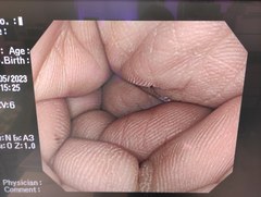大腸ビデオスコープ｜PCF-Q260AZI｜オリンパスメディカルシステムズ株式会社の写真6枚目