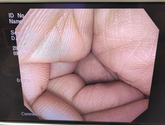 大腸ビデオスコープ｜PCF-Q150AI｜オリンパスメディカルシステムズ株式会社の写真6枚目