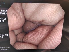大腸ビデオスコープ｜PCF-Q260AI｜オリンパスメディカルシステムズ株式会社の写真6枚目