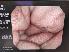 大腸ビデオスコープ｜PCF-Q260AI｜オリンパスメディカルシステムズ株式会社の写真6枚目