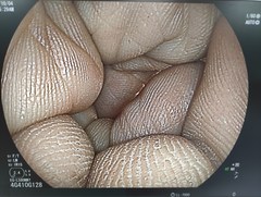 上部消化管用経鼻スコープ｜EG-L580NW7｜富士フイルムメディカルの写真6枚目