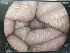 下部消化管用拡大スコープ｜EC-L600ZP7｜富士フイルムメディカルの写真6枚目