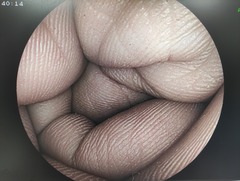 大腸ビデオスコープ｜EC-3000MP｜富士フイルムメディカルの写真6枚目