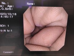 上部消化管汎用ビデオスコープ(径鼻)｜GIF-XP150N｜オリンパスメディカルシステムズ株式会社の写真6枚目