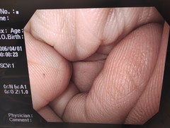 上部消化管汎用ビデオスコープ｜GIF-H260｜オリンパスメディカルシステムズ株式会社の写真6枚目