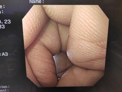 上部消化管汎用ビデオスコープ｜GIF-XQ240｜オリンパスメディカルシステムズ株式会社の写真6枚目