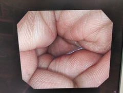大腸ビデオスコープ｜PCF-Q260AI｜オリンパスメディカルシステムズ株式会社の写真6枚目