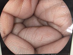 下部消化管用光学拡大スコープ｜EC-590ZW/M｜富士フイルムメディカルの写真6枚目
