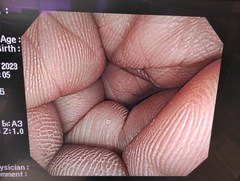 大腸ビデオスコープ｜CF-H260AI｜オリンパスメディカルシステムズ株式会社の写真6枚目