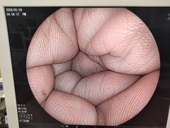 下部消化管用細径スコープ｜EC-590MP｜富士フイルムメディカルの写真6枚目