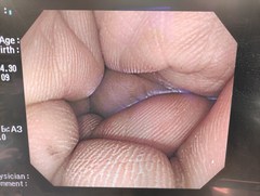 大腸ビデオスコープ｜PCF-Q260AI｜オリンパスメディカルシステムズ株式会社の写真6枚目