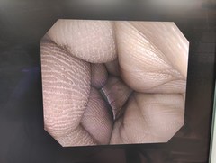 大腸ビデオスコープ｜PCF-Q150AI｜オリンパスメディカルシステムズ株式会社の写真6枚目