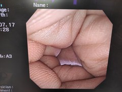 上部消化管汎用ビデオスコープ(径鼻対応)｜GIF-XP260N｜オリンパスメディカルシステムズ株式会社の写真6枚目