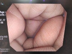 大腸ビデオスコープ｜PCF-Q260AI｜オリンパスメディカルシステムズ株式会社の写真6枚目