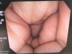 大腸ビデオスコープ｜PCF-Q260AI｜オリンパスメディカルシステムズ株式会社の写真6枚目