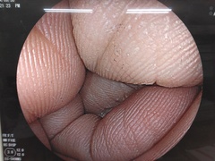 大腸ビデオスコープ｜EC-590WM3｜富士フイルムメディカルの写真6枚目