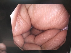 大腸ビデオスコープ｜PCF-H290ZI｜オリンパスメディカルシステムズ株式会社の写真6枚目
