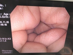 Video Colonoscope｜PCF-Q260AI｜Olympus Medical Systems photo6