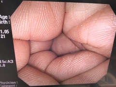 大腸ビデオスコープ｜CF-Q240I｜オリンパスメディカルシステムズ株式会社の写真6枚目