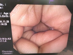 大腸ビデオスコープ｜PCF-Q260AI｜オリンパスメディカルシステムズ株式会社の写真6枚目