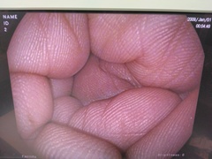 上部消化管スコープ｜EG16-K10｜ペンタックスの写真6枚目