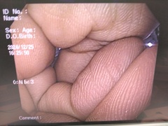 上部消化管汎用ビデオスコープ｜GIF-Q150X｜オリンパスメディカルシステムズ株式会社の写真6枚目