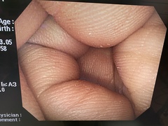 大腸ビデオスコープ｜PCF-Q260AI｜オリンパスメディカルシステムズ株式会社の写真6枚目